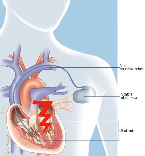 Mi sottoporrò ad un impianto di pacemaker